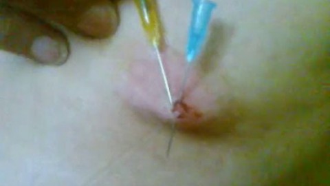 Needles in tits