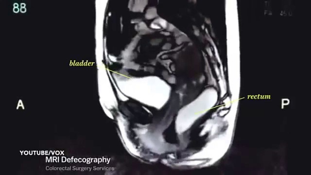 amazing mri scan video captures hd portn, nerorentou - PeekVids